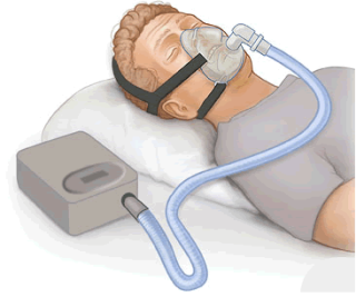 CPAP-Beatmung: Beatmungsgerät, Schlauchsystem und Maske