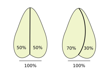 Schemadarstellung: Gerade und schiefe Nasenscheidewand im Vergleich