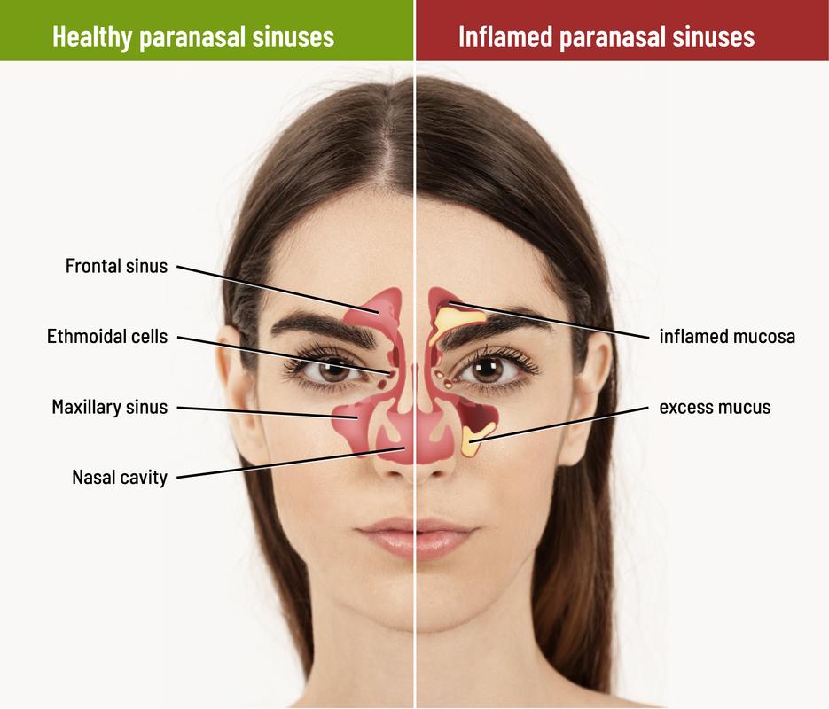 Nasal mucosa inflammation
