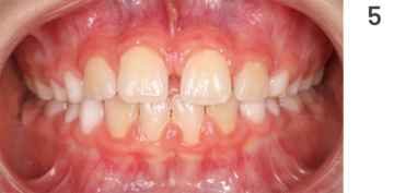 Figure 5: Treatment course of open bite, final result