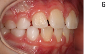 Figure 6: Treatment course of open bite, final result